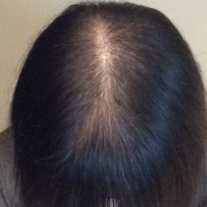 50代女性の育毛施術前