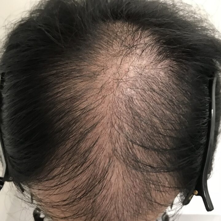 30代男性の育毛施術前