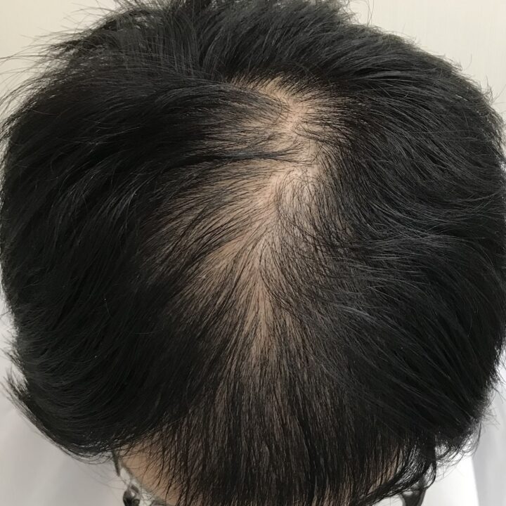 30代男性の育毛施術後