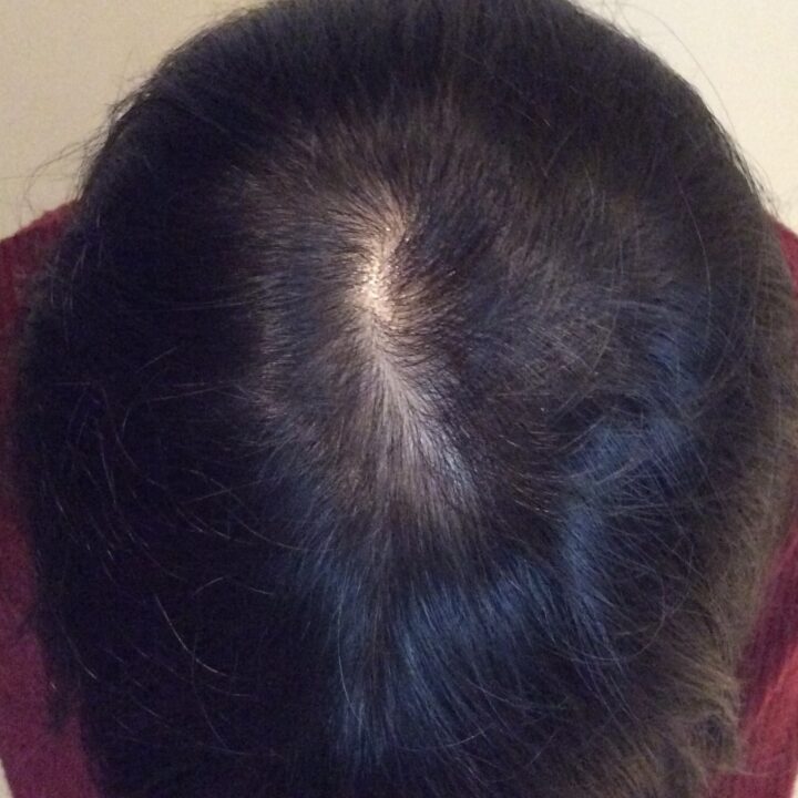 50代女性の育毛施術後