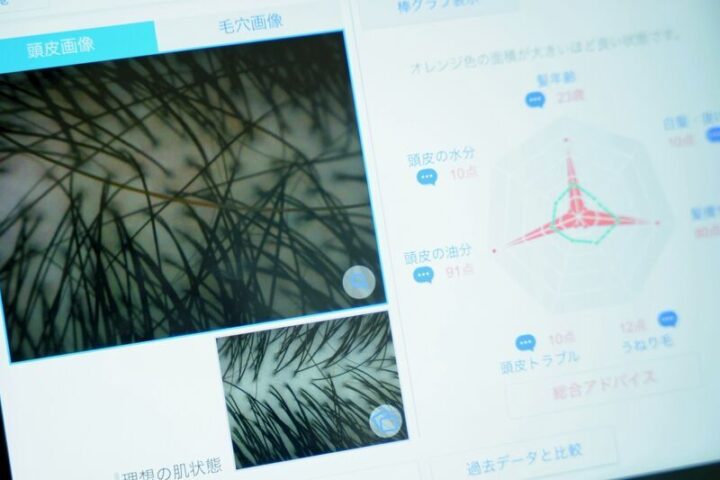 マイクロスコープによる<br>頭皮診断