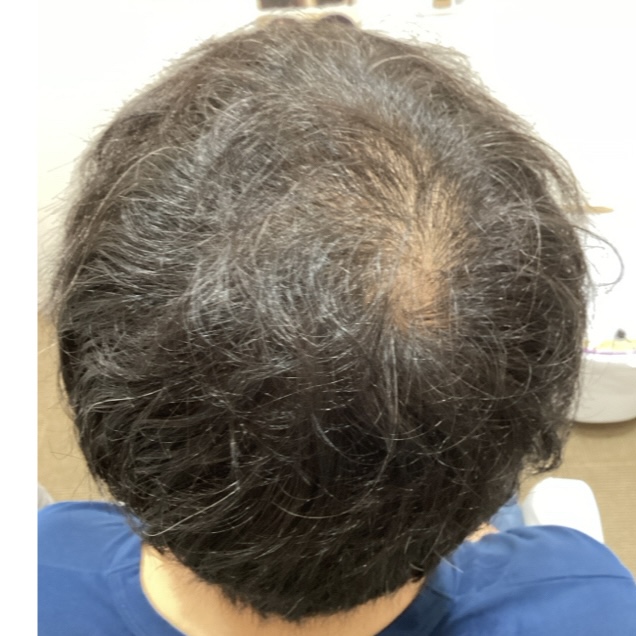 つむじが薄い30代男性の薄毛対策事例・千葉県流山市から来店の画像