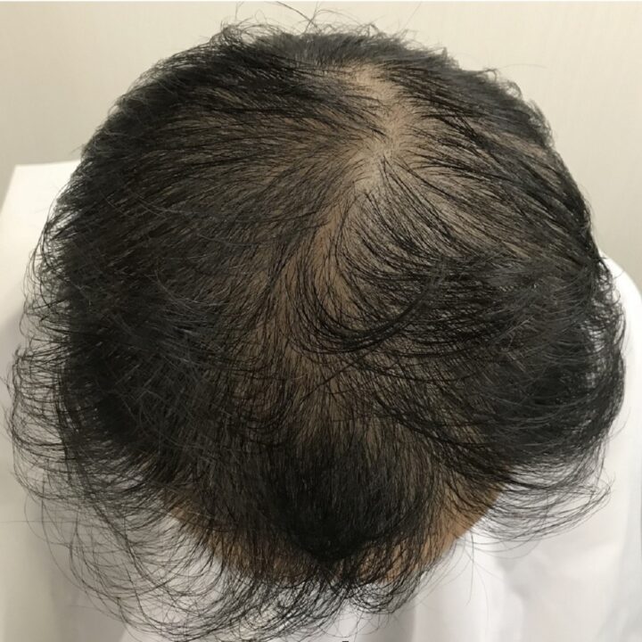 薄いつむじと白髪が悩みの40代男性の対策事例・横浜市から来店の画像