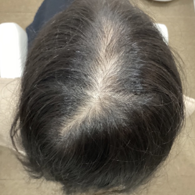 薄い分け目が気になる20代女性の対策事例・千代田区から来店の画像